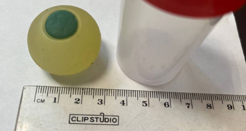 Врачи неделю не могли понять, что вызвало непроходимость: силиконовый глаз не видно на рентгене