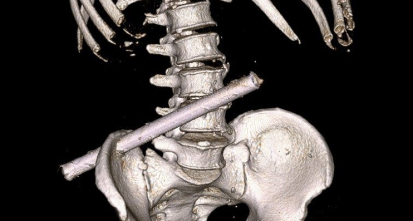 Пьяный житель Чувашии три дня ходил с 25-сантиметровой трубой в теле после падения в погреб